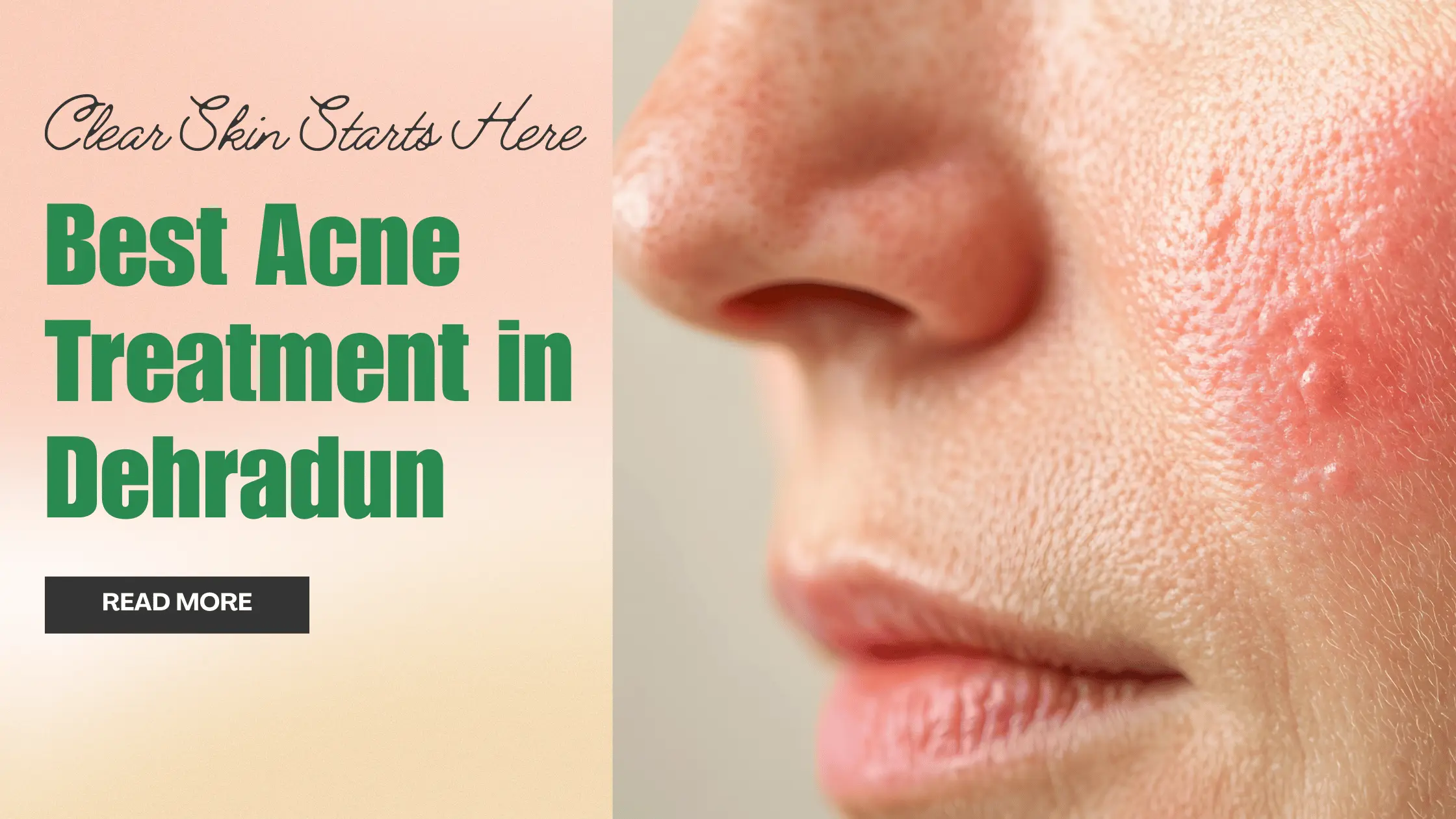best acne treatment in dehradun